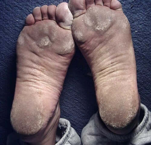 Ranorex cracked feet